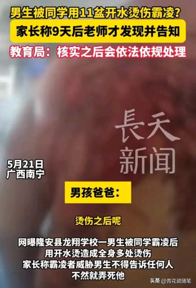 禽兽不如，13岁小男孩，被同学泼11盆开水霸凌，9天之后伤重后续