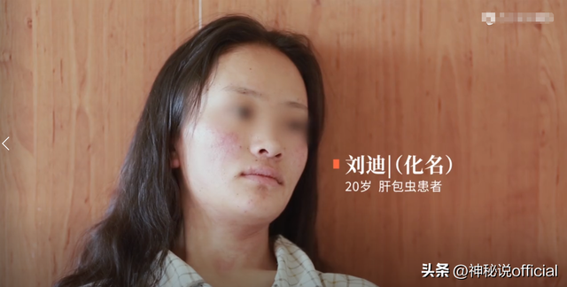 西藏女大学生患绝症，密密麻麻的虫子爬满肝脏，同学见了都躲着走