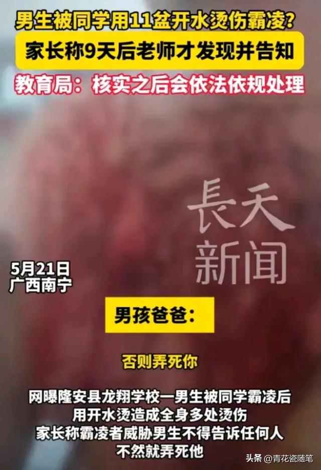 禽兽不如，13岁小男孩，被同学泼11盆开水霸凌，9天之后伤重后续