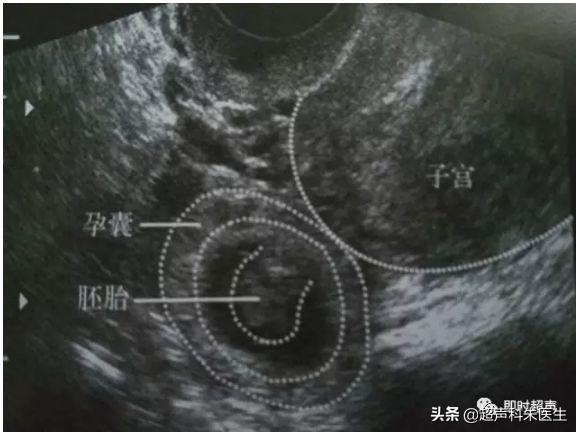 超声图解：常见16种妇科疾病典型超声表现