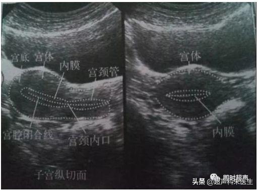 超声图解：常见16种妇科疾病典型超声表现