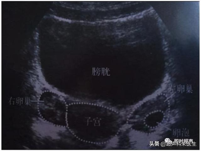 超声图解：常见16种妇科疾病典型超声表现