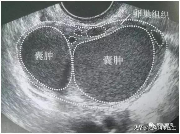 超声图解：常见16种妇科疾病典型超声表现