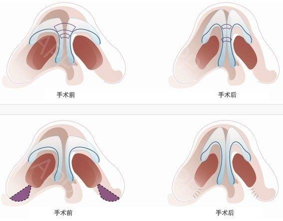 那些明星同款鼻子都是天生的吗？看完这个你也能拥有