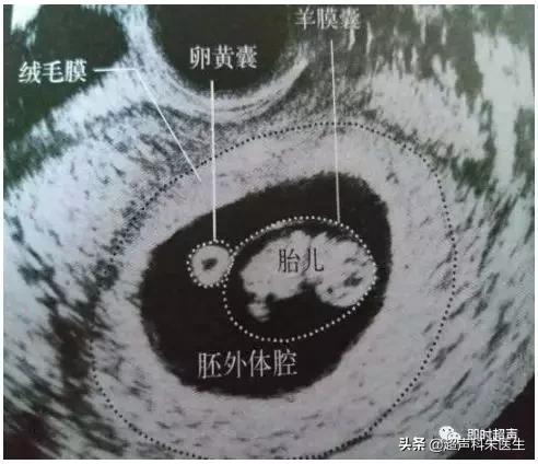 超声图解：常见16种妇科疾病典型超声表现