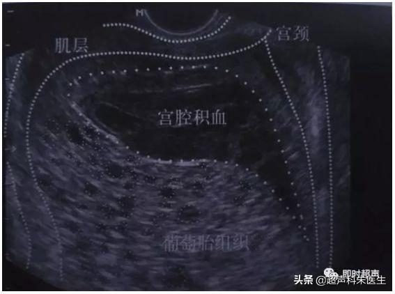 超声图解：常见16种妇科疾病典型超声表现