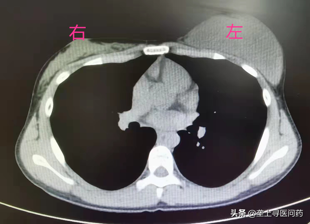 13岁少女胸部突然变大，医生：是肿瘤