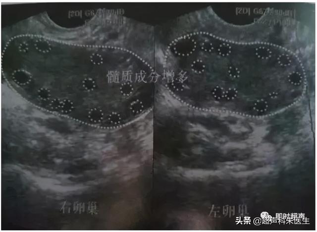 超声图解：常见16种妇科疾病典型超声表现