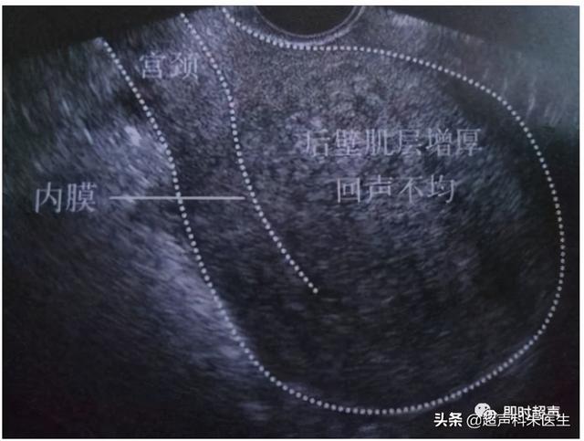 超声图解：常见16种妇科疾病典型超声表现