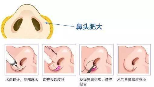 那些明星同款鼻子都是天生的吗？看完这个你也能拥有