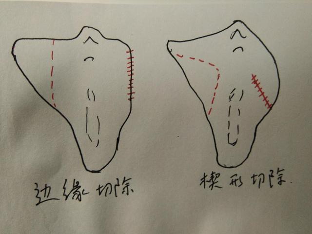 夏天到了，咱们来聊个羞羞的话题——小阴唇整形术