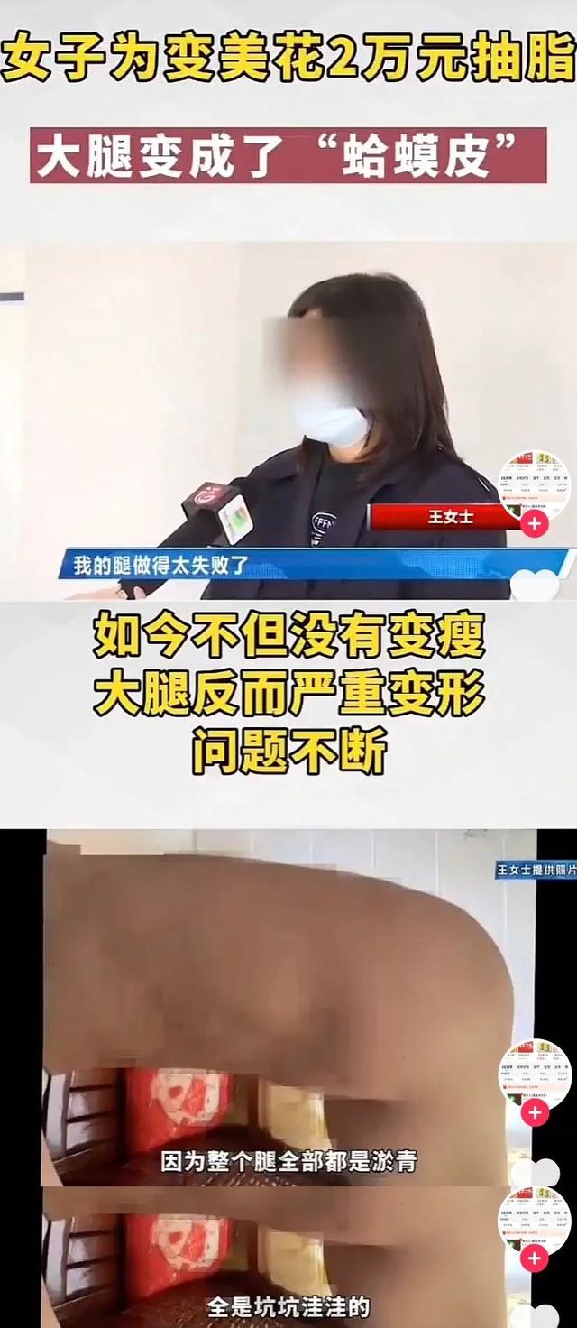 33岁女网红抽脂后“活活疼死”！全身感染溃烂，惨不忍睹……