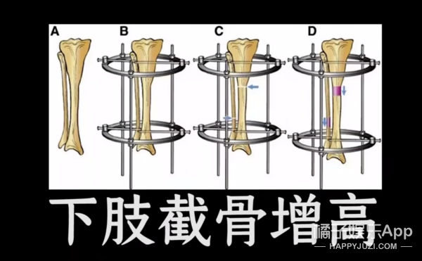 整容整疯了？拆肋瘦腰手指溶脂等手术层出不穷，为了美命都不要？