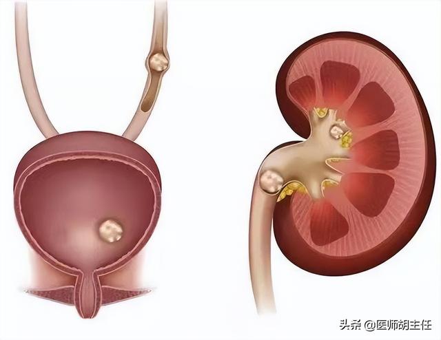 体检查出肾结石怎么办？医生：2个方法，或能让肾结石离开身体