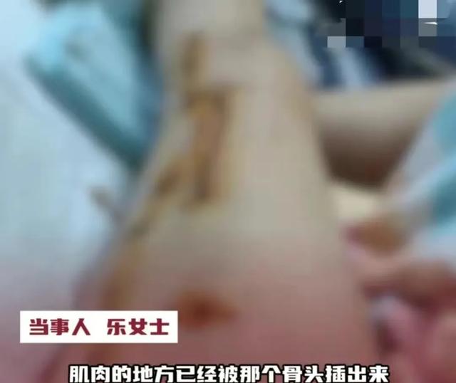 瑜伽课惊变 女学员被老师压断腿 巨响震荡 令人毛骨悚然的骨头碎裂声