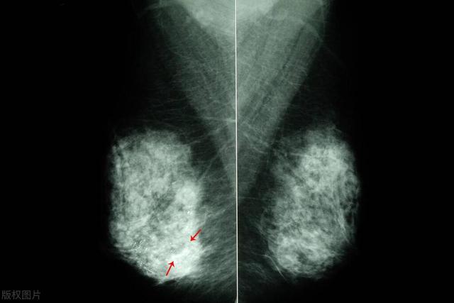 女性胸部异常瘙痒，检查发现乳腺癌：身体瘙痒可能隐藏疾病