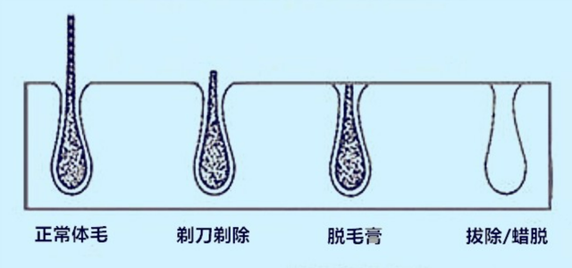 美少女必看攻略：夏季如何让脱毛更加简单