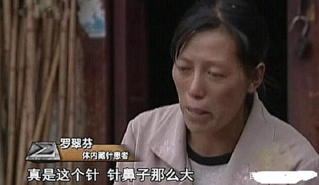 云南农妇经常浑身疼痛，2004年检查后发现体内有26根针，长达30年