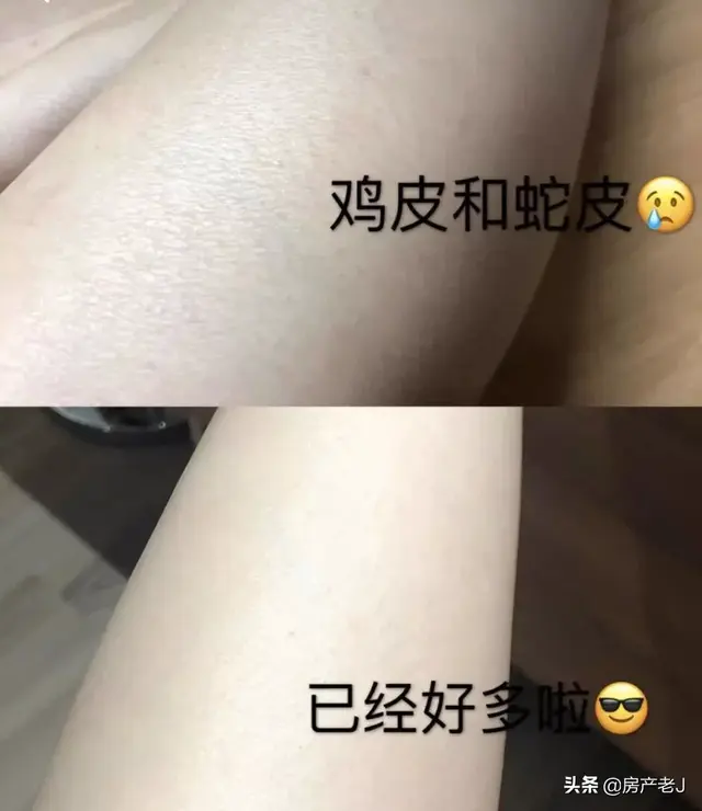 一到冬天，满身皮屑，腿上长“鱼鳞”？教你一小窍门，抹一下就好