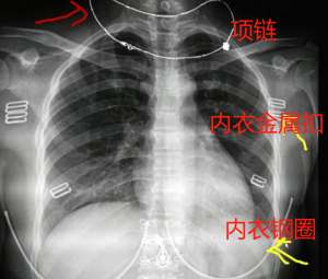 美女胸罩里面长什么样(女性拍胸片为什么要脱胸罩？做胸透和拍胸片有什么不同？)