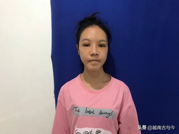 越南龅牙妹天生牙齿畸形，决心整容后，从丑女变成大美女