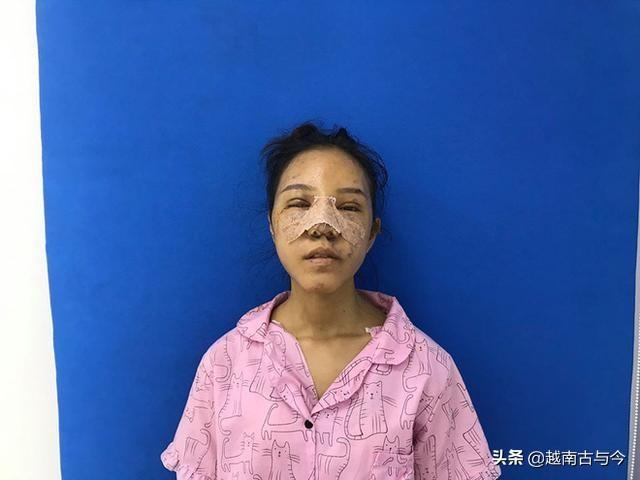 越南龅牙妹天生牙齿畸形，决心整容后，从丑女变成大美女