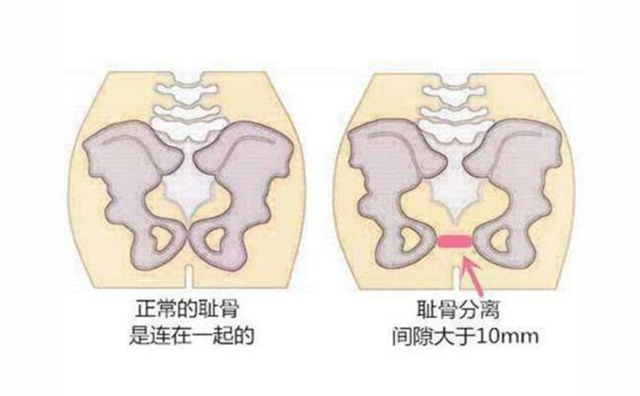 “少女臀”和“妈妈臀”有啥区别？看李若彤和钟丽缇就明白了