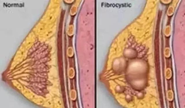 乳房里面的水泡泡—“乳腺囊肿”