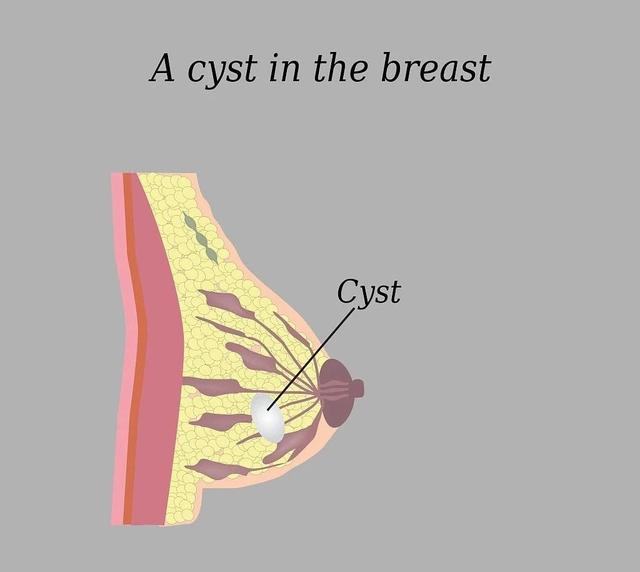 乳房里面的水泡泡—“乳腺囊肿”